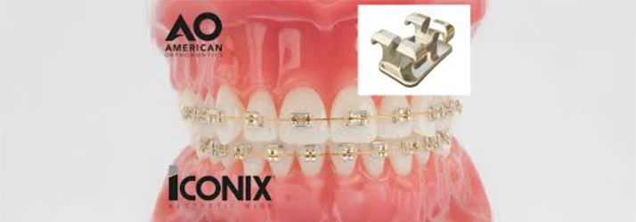 Orthodontist West Chester PA Iconix Example photo of iconix braces on a set of model teeth